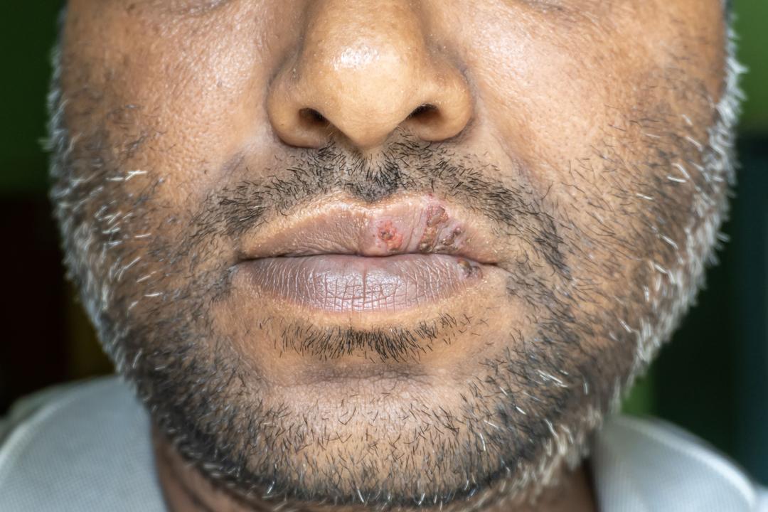 Cold sore/HSV treatment