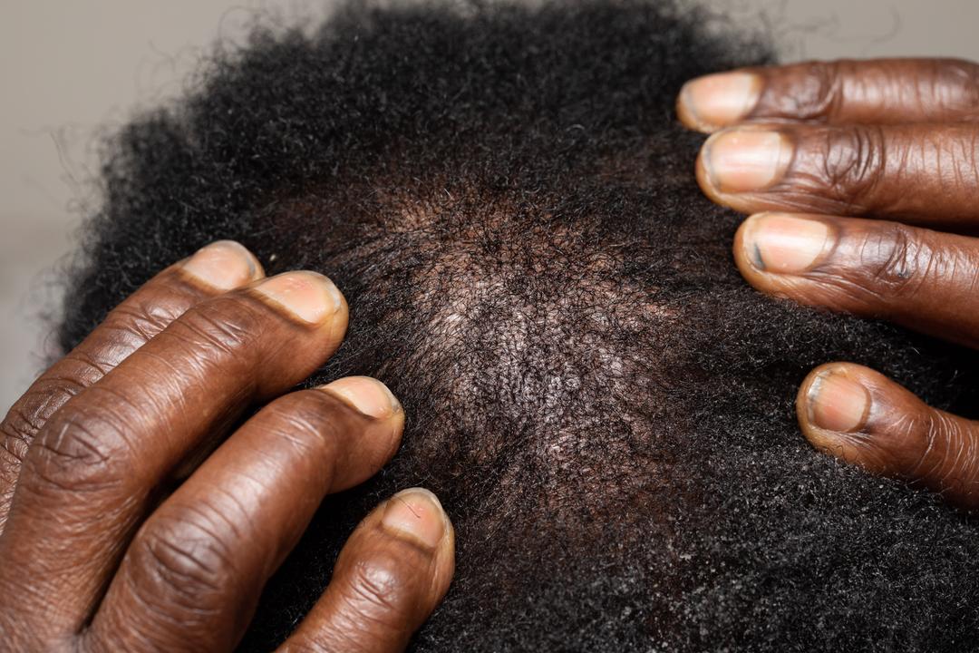 New treatment for hair loss