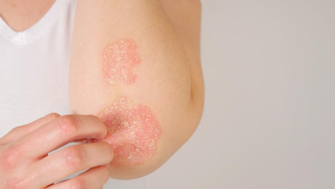 Psoriasis