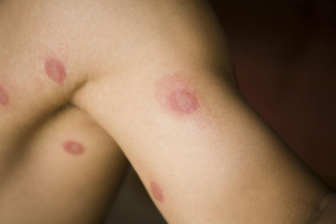 Ringworm (tinea)