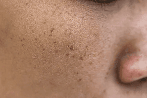 Sudden Grainy Skin Texture on Face